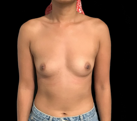 Breast augmentation - 308