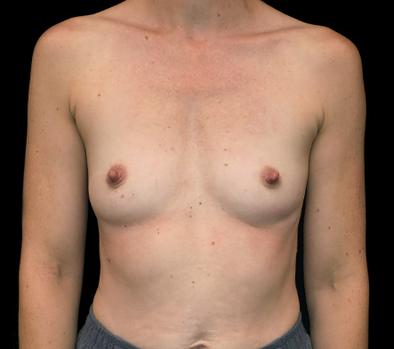 Breast augmentation - 296