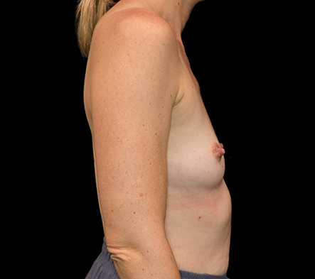 Breast augmentation - 298
