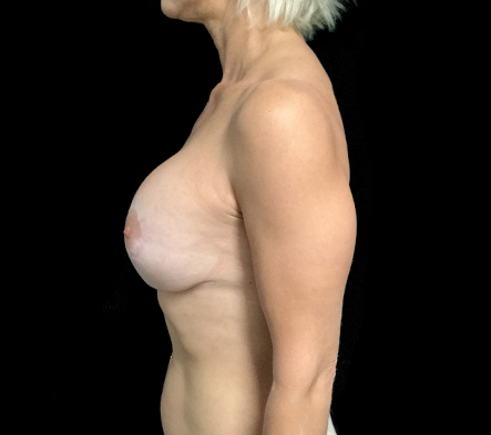 Breast implant revision landing pg - 44