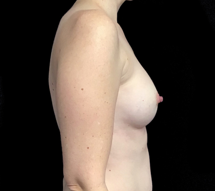 Breast fat grafting surgery - 19