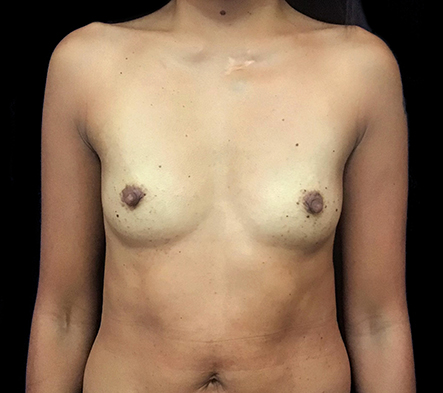 Medium breast implants - 27