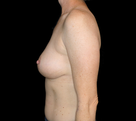 Breast Reduction and Abdominoplasty - 12