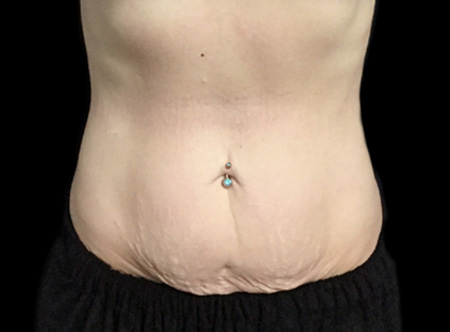 Postpartum abdominoplasty with abdominal wall reconstruction - 94