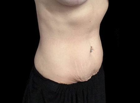 Postpartum abdominoplasty with abdominal wall reconstruction - 95