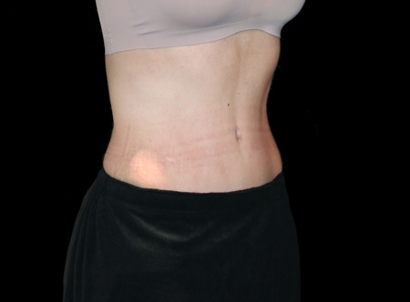 Postpartum abdominoplasty with abdominal wall reconstruction - 98
