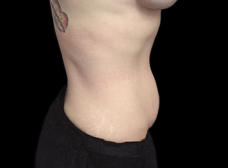Postpartum abdominoplasty with abdominal wall reconstruction - 96