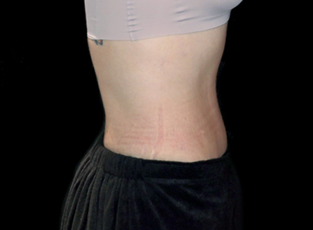Postpartum abdominoplasty with abdominal wall reconstruction - 99
