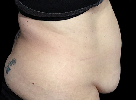 Postpartum abdominoplasty with abdominal wall reconstruction - 89
