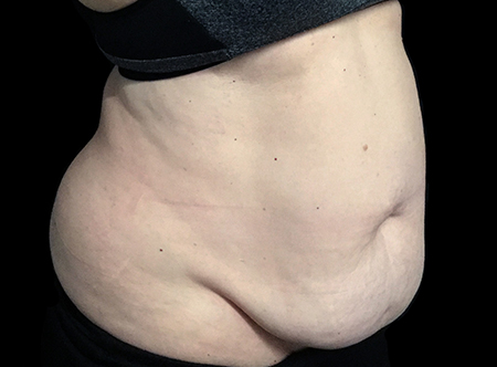Postpartum abdominoplasty with abdominal wall reconstruction - 90