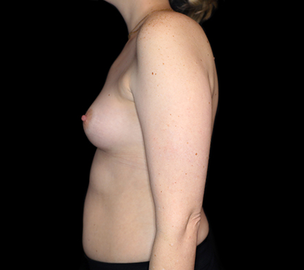Medium breast implants - 8