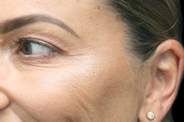 Cosmetic wrinkle injections - 44