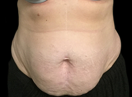 Postpartum abdominoplasty with abdominal wall reconstruction - 82