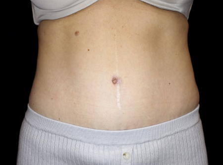 Postpartum abdominoplasty with abdominal wall reconstruction - 85