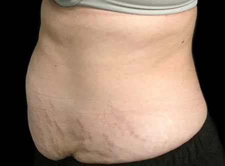 Postpartum abdominoplasty with abdominal wall reconstruction - 83
