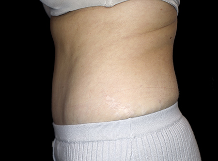 Postpartum abdominoplasty with abdominal wall reconstruction - 86