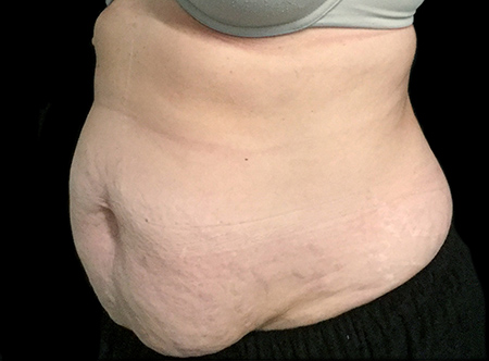 Postpartum abdominoplasty with abdominal wall reconstruction - 84
