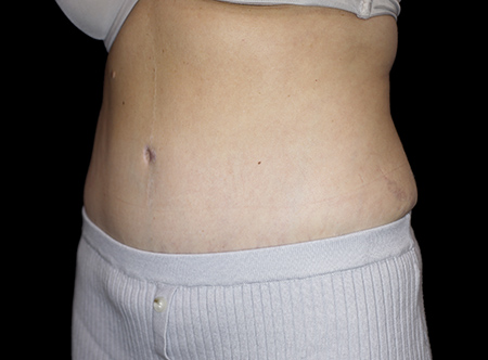 Postpartum abdominoplasty with abdominal wall reconstruction - 87