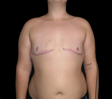 Subcutaneous bilateral mastectomy - 14