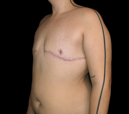 Subcutaneous bilateral mastectomy - 15