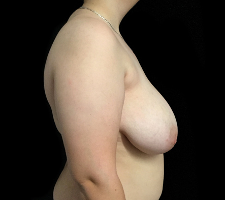 Subcutaneous bilateral mastectomy - 13