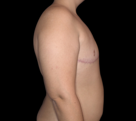 Subcutaneous bilateral mastectomy - 16