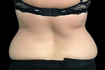 Liposuction | 5
