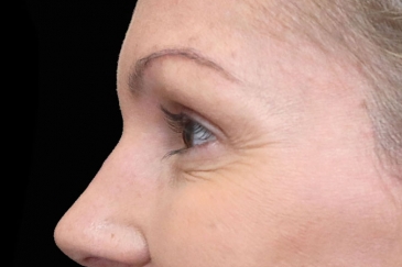 Cosmetic wrinkle injections - 39