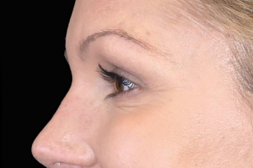 Cosmetic wrinkle injections - 41