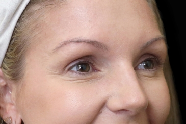 Cosmetic wrinkle injections - 40