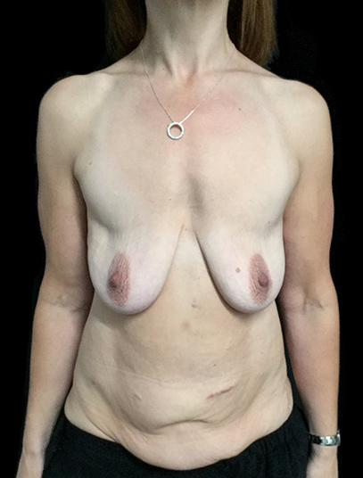 Postpartum abdominoplasty with abdominal wall reconstruction - 38