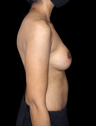 Postpartum abdominoplasty with abdominal wall reconstruction - 49