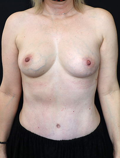 Postpartum abdominoplasty with abdominal wall reconstruction - 23