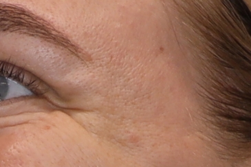 Cosmetic wrinkle injections - 35