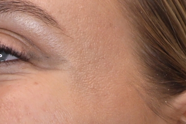 Cosmetic wrinkle injections - 36