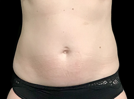 Postpartum abdominoplasty with abdominal wall reconstruction - 160