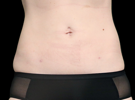 Postpartum abdominoplasty with abdominal wall reconstruction - 163