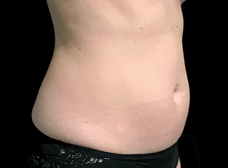 Postpartum abdominoplasty with abdominal wall reconstruction - 161