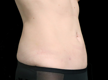 Postpartum abdominoplasty with abdominal wall reconstruction - 164