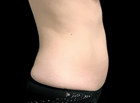 Postpartum abdominoplasty with abdominal wall reconstruction - 162