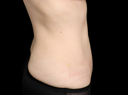 Postpartum abdominoplasty with abdominal wall reconstruction - 165