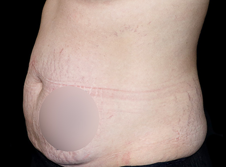 Postpartum abdominoplasty with abdominal wall reconstruction - 154