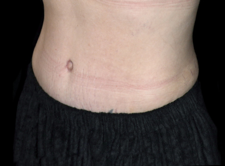 Postpartum abdominoplasty with abdominal wall reconstruction - 157