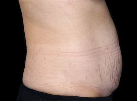 Postpartum abdominoplasty with abdominal wall reconstruction - 155