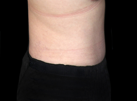 Postpartum abdominoplasty with abdominal wall reconstruction - 158