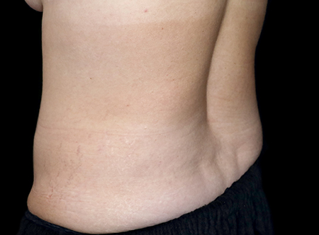 Postpartum abdominoplasty with abdominal wall reconstruction - 156