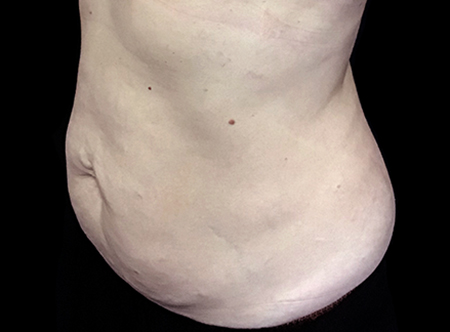 Postpartum abdominoplasty with abdominal wall reconstruction - 136
