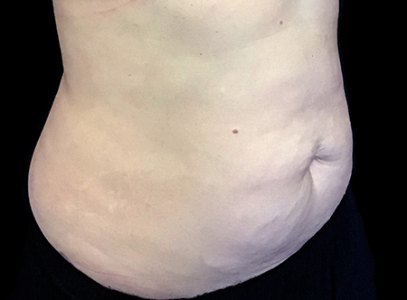 Postpartum abdominoplasty with abdominal wall reconstruction - 137
