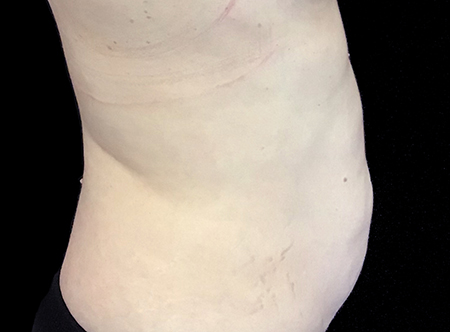 Postpartum abdominoplasty with abdominal wall reconstruction - 138