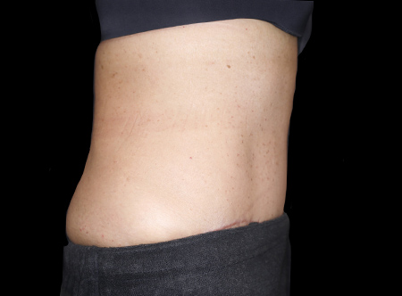 Postpartum abdominoplasty with abdominal wall reconstruction - 135